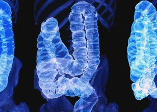 How do oral bacteria make colorectal cancer more aggressive?